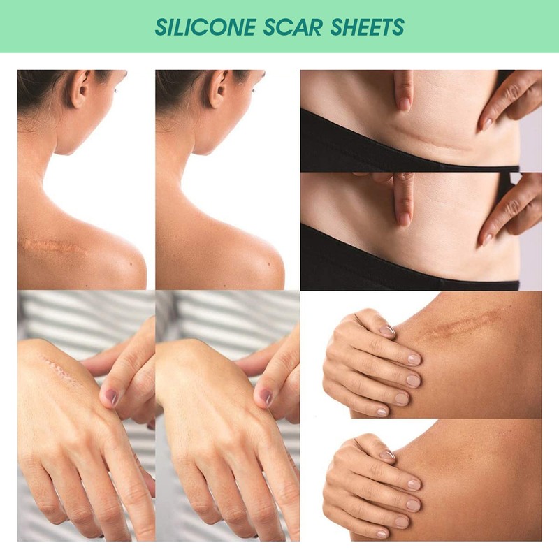 4 Pcs Elaimei Silicone Scar Sheets Stretch Marks Remover Post