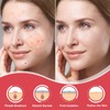 Pimple Patches for Face, Hydrocolloid Acne Patches Zit Patches for