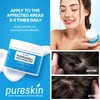 Scalp Cream for Psoriasis Folliculitis, Helps Relieve Itching Flaking, with