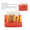 Dental Implant Teeth Model, Dental Implant Analysis Crown Bridge Model,