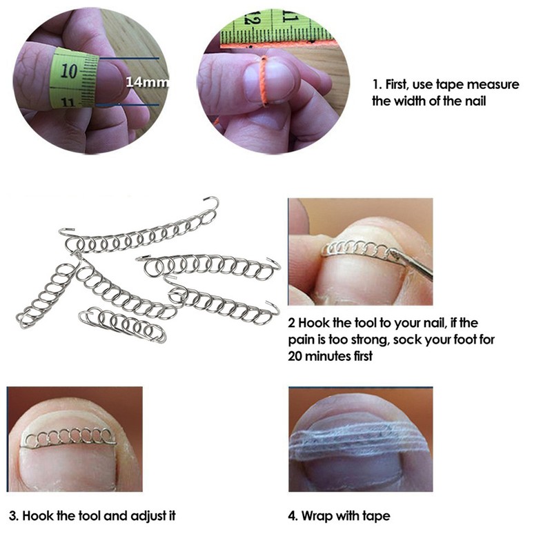 Ingrown Toenail Treatment Kit Glue Free Pedicure Ingrown Toenail Corrective