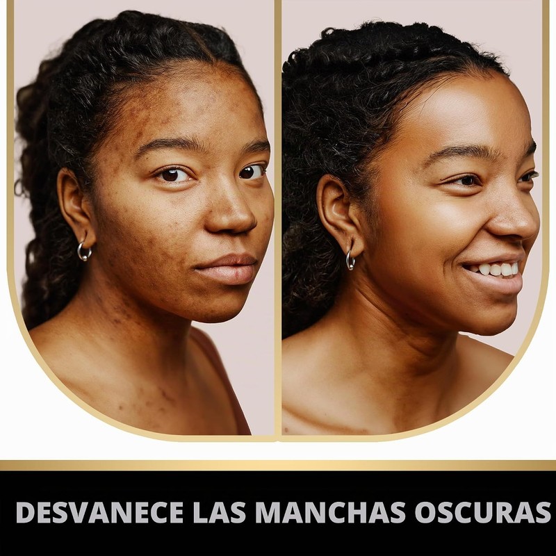 VALITIC Barras de jabón eliminadoras de manchas oscuras de ácido