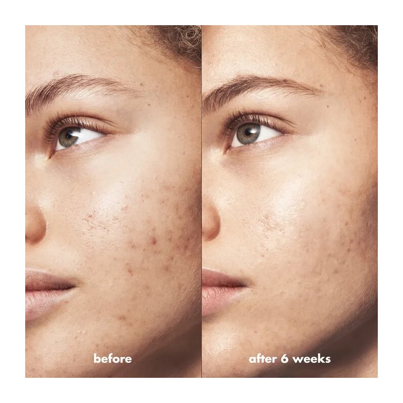 E.l.f. Skin Blemish Breakthrough - Gel Para Combatir El Acné