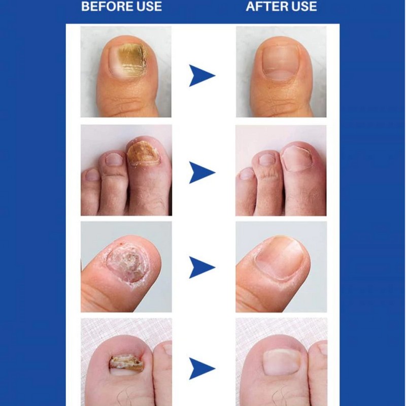 Enriched Vitamins (3 Bottle) Fungus Clear Premuim Probiotic Improves Toe