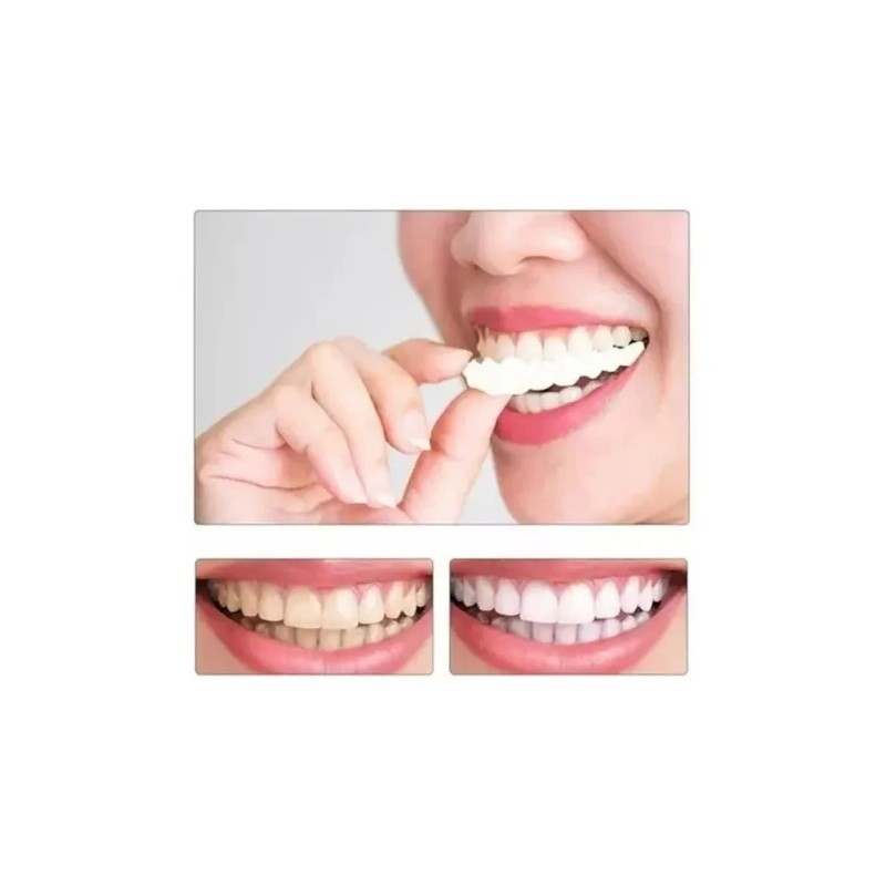 Carillas Estéticas Snap On Smile Veneers Dientes Temporales