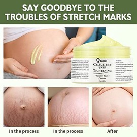 Crema Remoción de Estrías y Cicatrices para El Embarazo - Reparación de Cicatrices, Reafirmante Abdominal, y Suave Erradicación de Estrías Cuidado de 