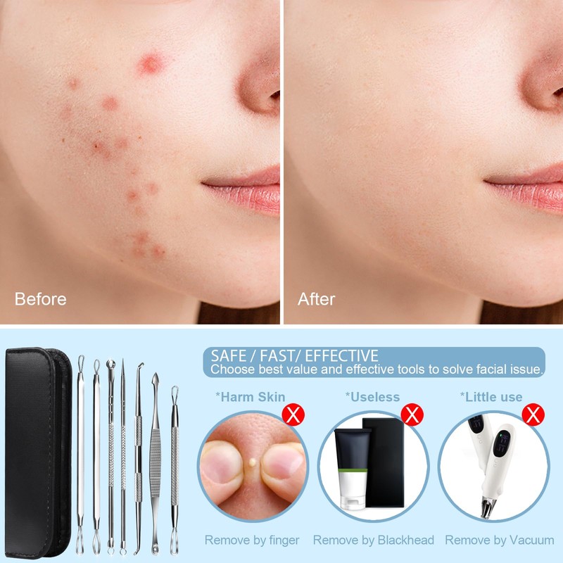 Teenitor 7 in 1 Pimple Popper Tool Kit - Blackhead
