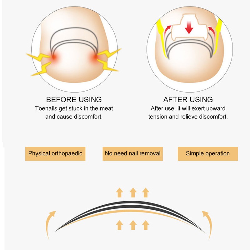 Ingrown Toenail Correction Patch Ingrown Nail Corrector Nail Insert Buckle