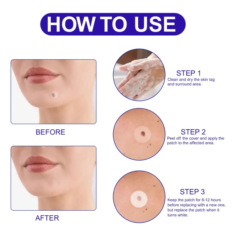 180 Pimple Patches Discretos Comodos Acné Verrugas Mezquinos