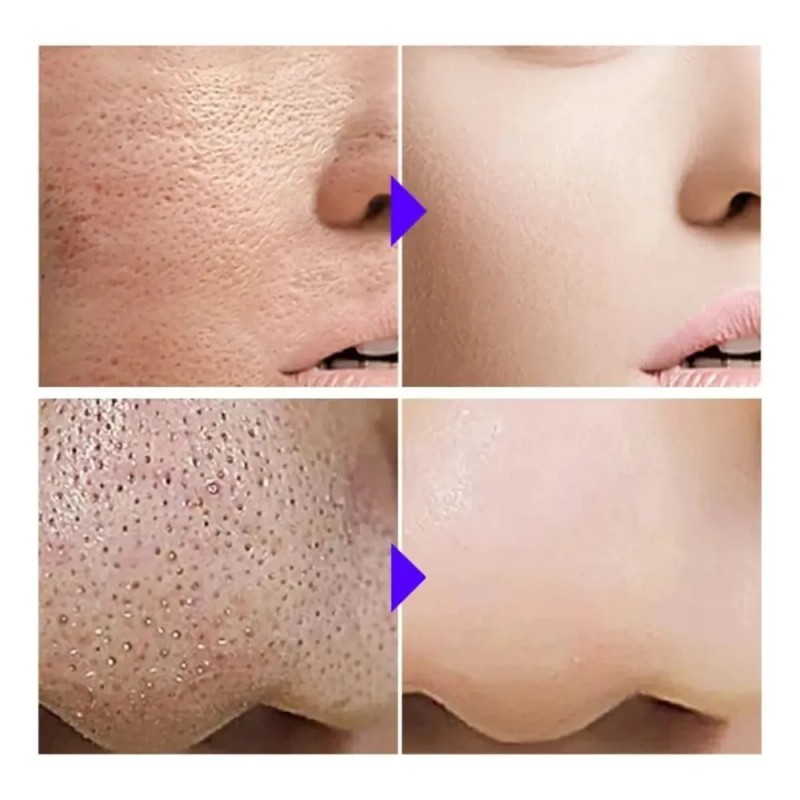 Gc Sérum Facial Reductor Poros Acido Salicílico Anti Acné