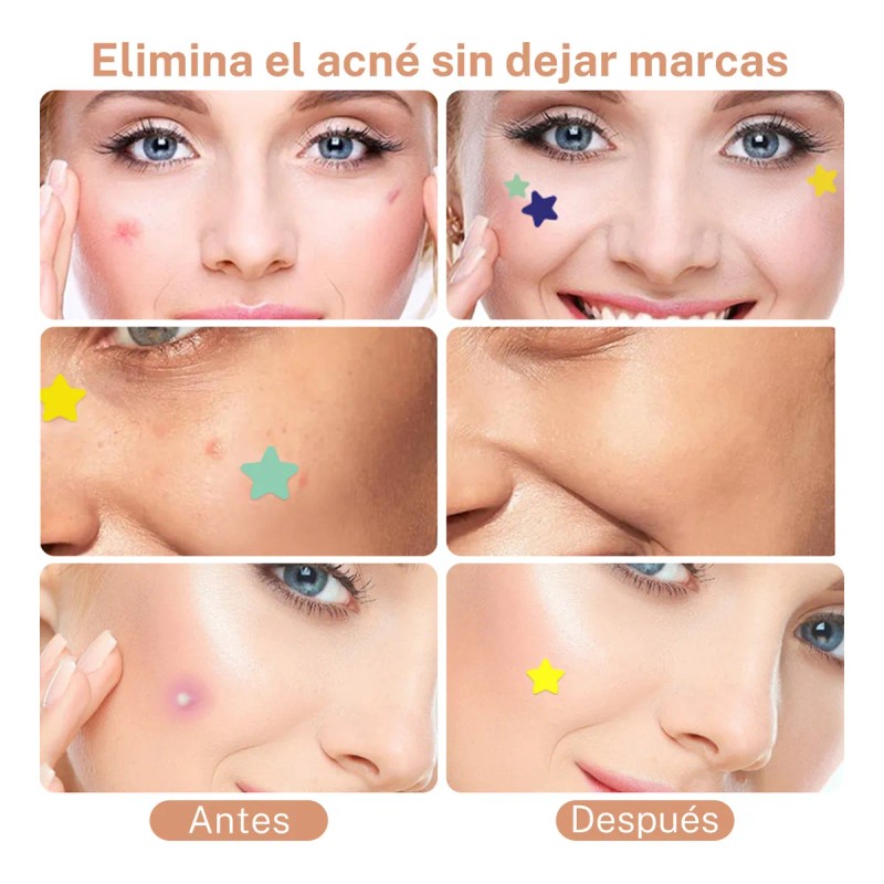 280pzs Mascarillas Estrella Acne