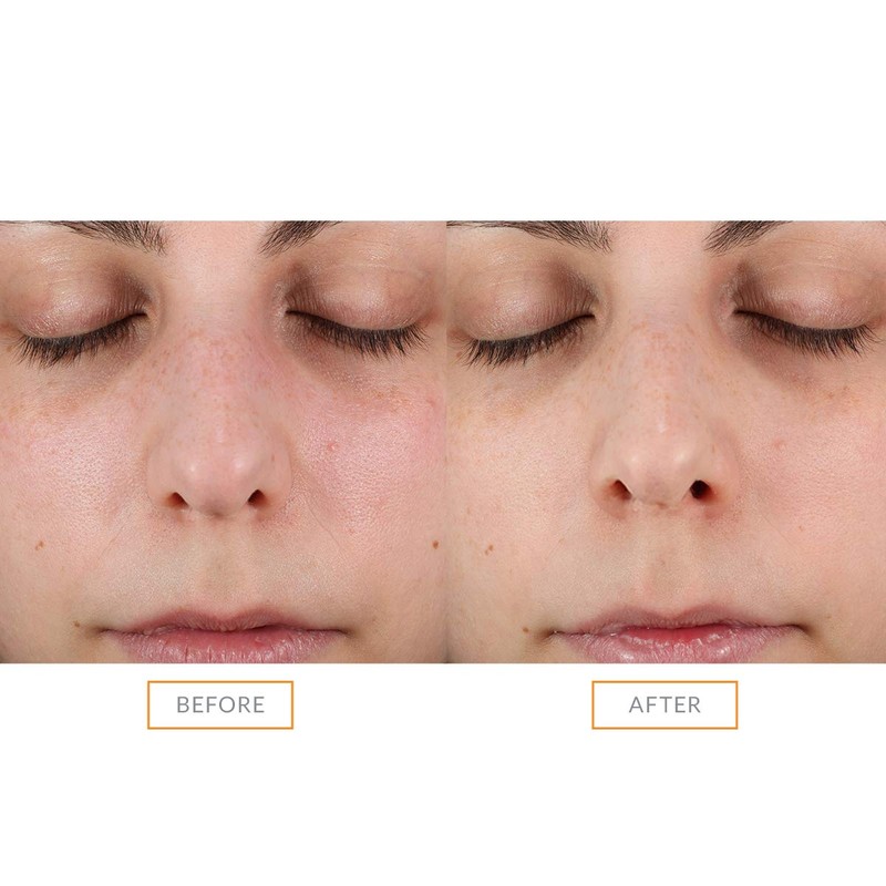 Clarisonic Sonic Exfoliator Facial Brush Head - Gentle & Effective