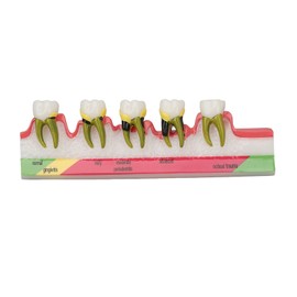Teeth Periodontal Disease Model Different Stages Resin Dental Periodontitis Display Model
