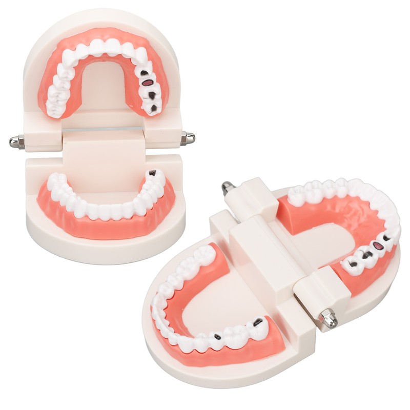Dental Disease Caries Teeth Model Resin Simulation Teaching Prop Dental