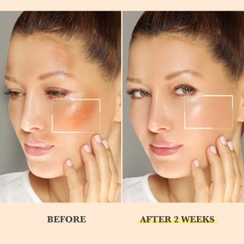 Chemical Peel for Face - Peeling Oil for Facial & Body Exfoliating with 16% Salicylic Acid - Dead Skin Remover with Gentle Formula for All Skin Type - 110mL(3.66OZ)