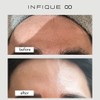 infique lamella lotion