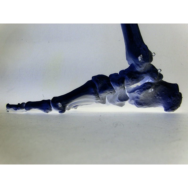 Orthopädische Weichpolstereinlage bei Hallux valgus stützt bei Knick- Senk- Spreizfüßen