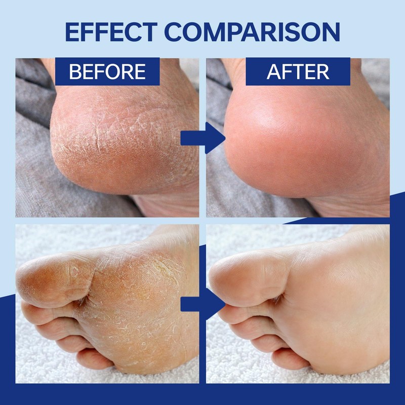 Urea Foot Cream 40%, Urea Cream with 2% Salicylic Acid