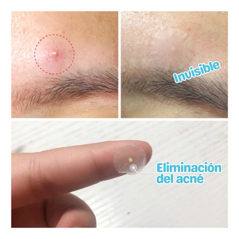 Lanbena Dúo Parches Tratamiento Día y Noche Eliminan Acné Piel