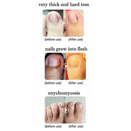 Toenail Clippers Nail Clippers Trimmer for Thick Fungus Ingrown Nails/Toenails - Soft Grip Long Handle Nail Clippers for Ingrown Toenails,Fingernail Clipper Stainless Steel（Black）