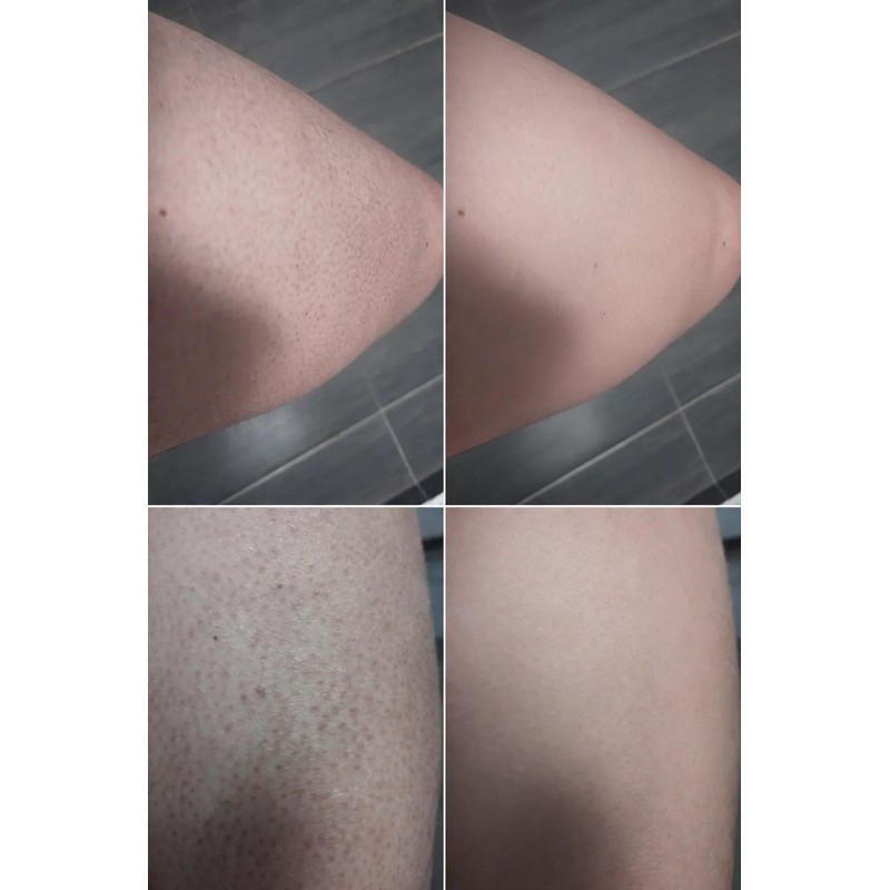 Keratosis Pilaris Body Wash – Targets Bumpy Skin, Strawberry Legs