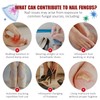 Fungal Nail Patches,32PCS Fungal Nail Patches for Toenails,Nail Repair for