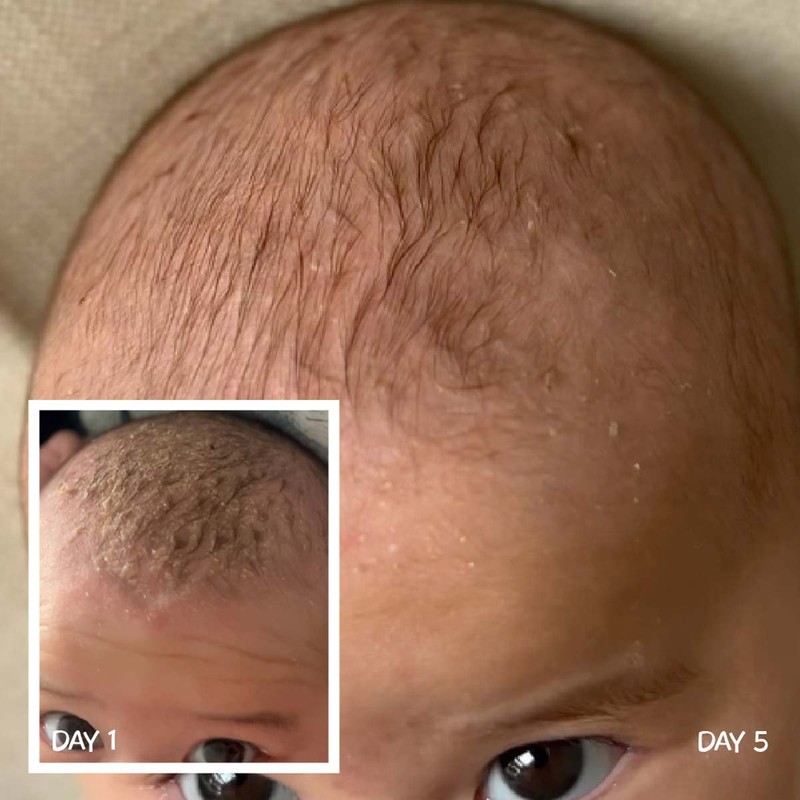 MooGoo Baby & Child Cradle Cap Scalp Cream, 120g