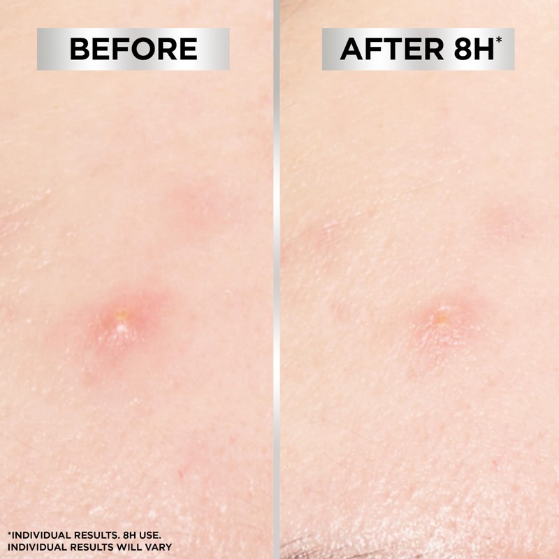 Garnier Garnier 8H Blemish Patches - Hydrocolloid patches to reduce