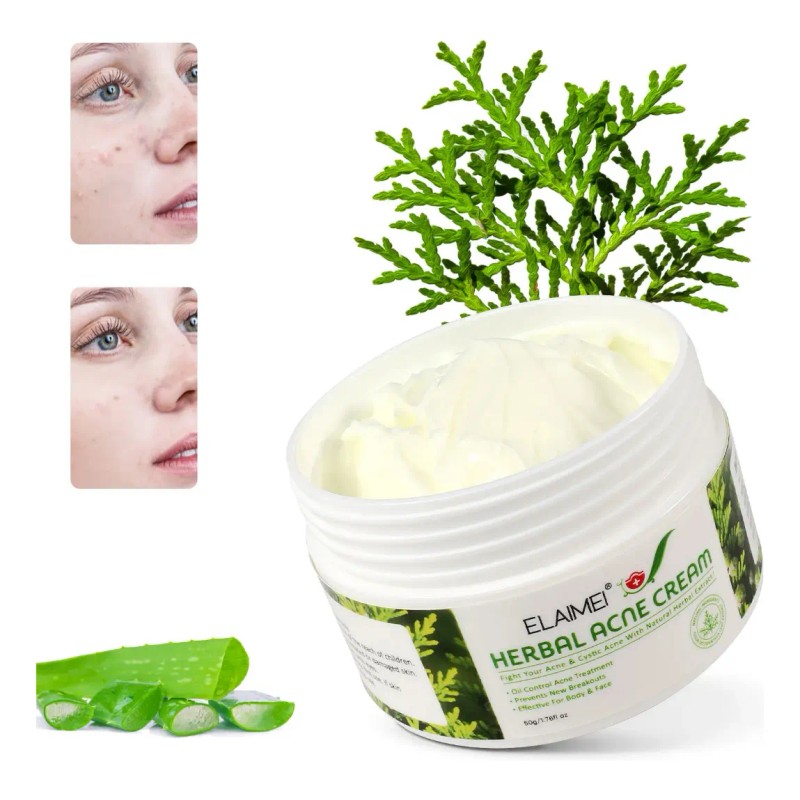 Crema Herbal Antiacné Control Grasa, Granos Espinillas 2 Pzs Acneica