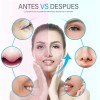 Apradas Tratamiento De Lifting Facial Exfoliante Ultrasónico Para La