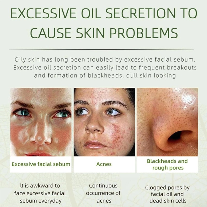 Grospe Acne Removing Face Cream,Natural Ingredients Professionally Remove Acne Marks,Fo