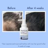 WishCare Hair Growth Serum with Rosemary, Redensyl, Anagain, Baicapil, Caffeine,