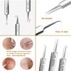 Professional Facial Blackhead Remover Tweezers,3Pcs Precision Pimple Popper Tool Kit