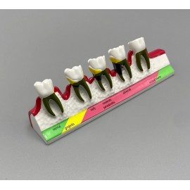 Unbranded Dental Teeth Model For Caries/Periodo - For Periodontal Disease