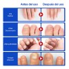 Líquido Hongos Tratamiento Uñas Grises P/ Uñas Enfermas