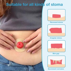 TNTNDAY 10PCS 4mm Thickness Moldable Ostomy Barrier Rings, Skin Extender Rings Medical Hydrocolloid Ostomy Bag Supplies,Seal No Leaking Barrier Rings for Personal Care