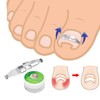 1pc Silver Ingrown Toenail Correction 17 to 22mm Adjustable Stainless