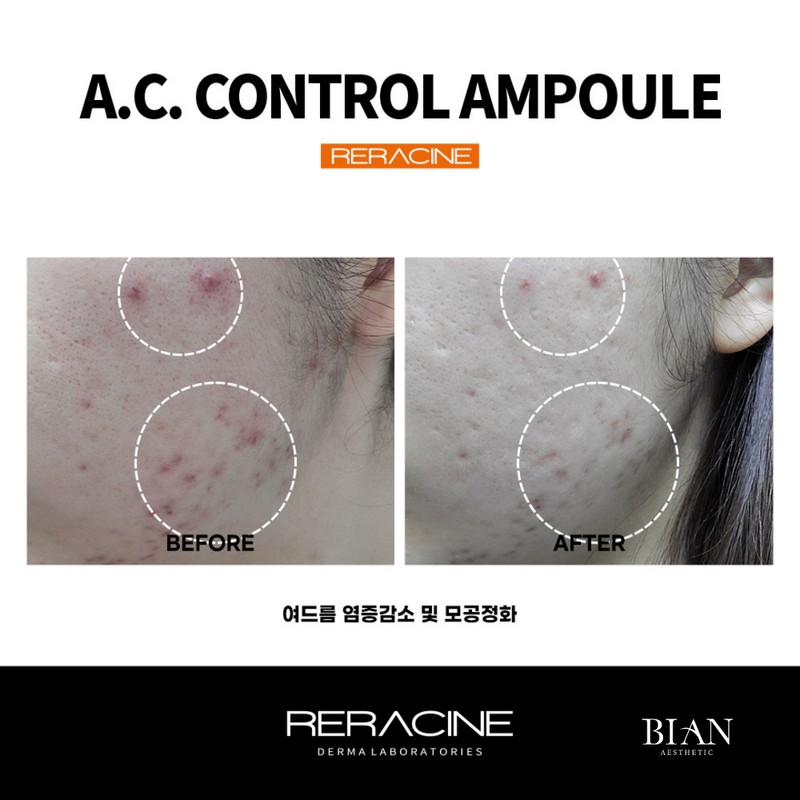 Lyricin Lilacin AC Control Ampoule 30ml / 리라신 AC컨트롤 앰플