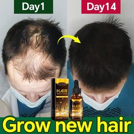 OUHOE Ginger Treatment Oil for Hair Growth,Hair Growth Serum,Biotin Hair Growth Oil,Hair Growth Ginger Serum for Men and Women,Hair Growth Treatment,Hair Loss Treatment,Promotes Thicker,Growth Hair. promote hair - Specification: 1 pcs