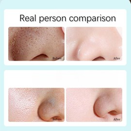 Acid Acne Treatment Gel,Anti Acne Face Cream,Acid Face Cream,Skincare for All Skin Types,Light Texture,Female Facial Essence Cream,Help Improve Skin Tone,Refreshing and Comfortable