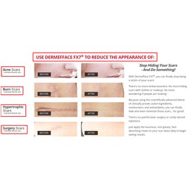 Skinception Dermefface FX7 Scar Reduction and Acne Burn Removal Therapy 0.5 Fluid Ounce Pack 3