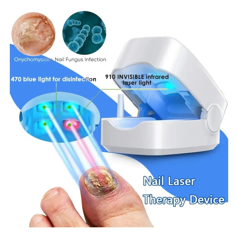 Laser Para Quitar Hongos De Las Uñas. Onicomicosis. Blanco