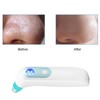 KD802 Blackhead Remover Pore Vacuum Pimple Extractor Acne Removal Kit