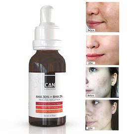 ican London AHA 30% + BHA 2% Serum - Healthy Exfoliating Brightening Facial Serum 30ml