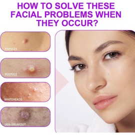 2PCS Acid 12% Facial Serum Cream, Acid Serum Face Cream for Acne Treatment & Dark Spot Remover, Reduces Redness, Fades Spots, Face Spot Cream With Niacinamide & Vitamin C for All Skin Types -20g*2