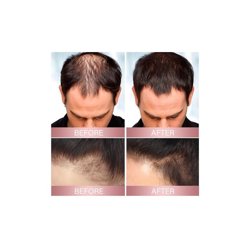 Vrpshe Hair Growth Spray with Rice Water – Biotin and
