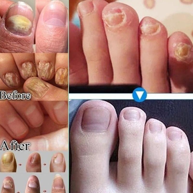 JAYSUING Ginger Nail Care Liquid, Nail Nutrients, Repairs Damaged and