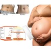 Tratamiento Profesional Permanente Eliminar Estrías Neutra