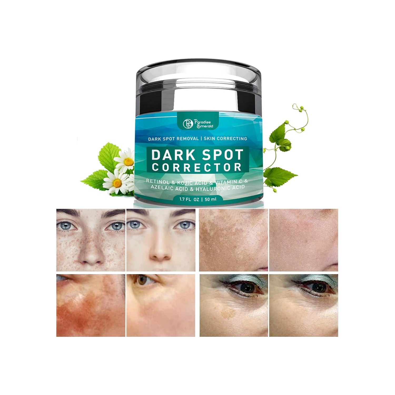 Dark Spot Remover for Face, Hyperpigmentation Treatment, Melasma