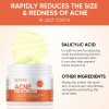 Crema Facial De Acné, Tratamiento Con Acné Quístico De Ácido